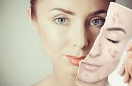 Αντικαταστήστε το Botox
