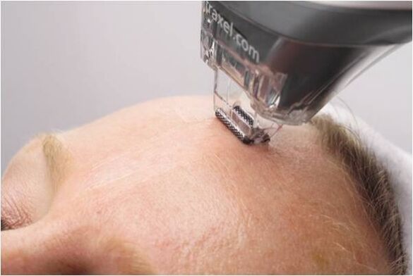 Διαδικασία peeling για την αναζωογόνηση του δέρματος του προσώπου
